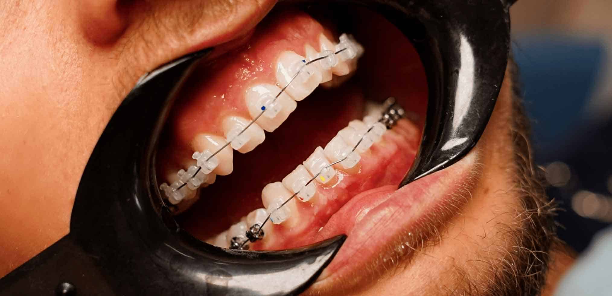 Керамічні брекети