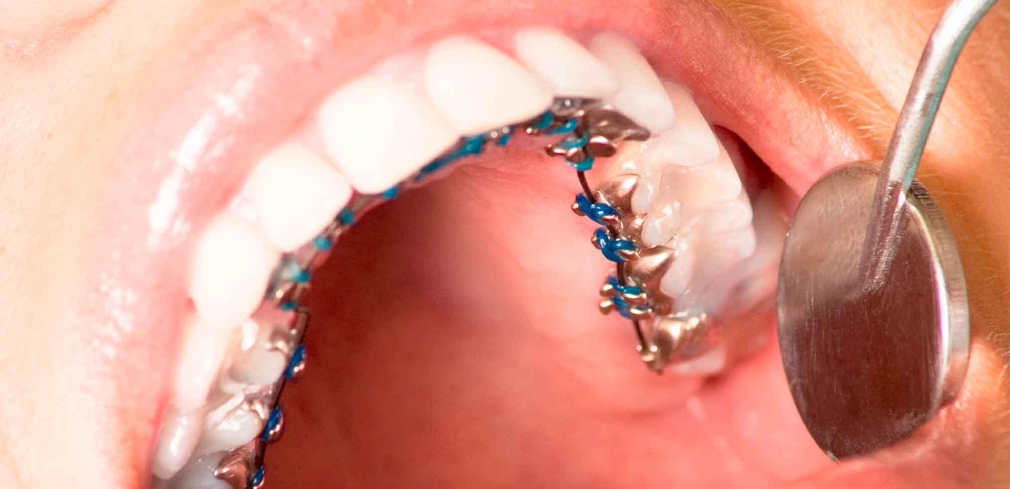 Лінгвальні брекети