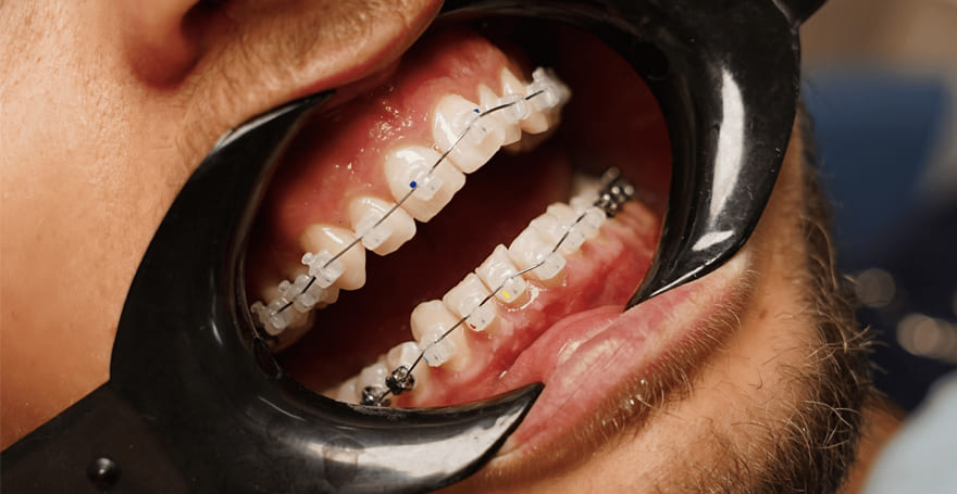Як доглядати за брекетами?